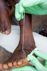 A Guinea worm emerging from a child’s foot in Ghana. Photo courtesy of The Carter Center/Louise Gubb. 